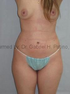  Before and After Cosmetic Surgery in Oakland, CA 