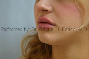  Before and After Cosmetic Surgery in Oakland, CA 