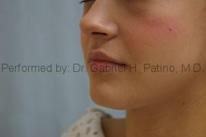  Before and After Cosmetic Surgery in Oakland, CA 