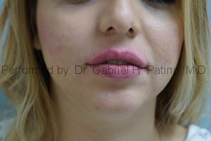  Before and After Cosmetic Surgery in Oakland, CA 