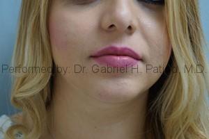  Before and After Cosmetic Surgery in Oakland, CA 