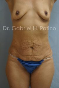  Before and After Cosmetic Surgery in Oakland, CA 