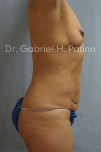  Before and After Cosmetic Surgery in Oakland, CA 