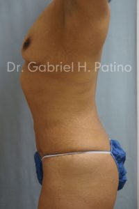  Before and After Cosmetic Surgery in Oakland, CA 