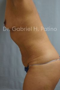  Before and After Cosmetic Surgery in Oakland, CA 