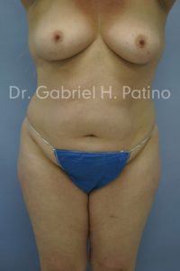  Before and After Cosmetic Surgery in Oakland, CA 