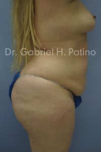  Before and After Cosmetic Surgery in Oakland, CA 