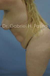  Before and After Cosmetic Surgery in Oakland, CA 