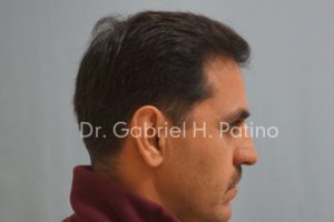  Before and After Cosmetic Surgery in Oakland, CA 