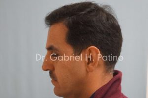  Before and After Cosmetic Surgery in Oakland, CA 