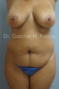  Before and After Cosmetic Surgery in Oakland, CA 