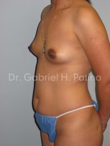  Before and After Cosmetic Surgery in Oakland, CA 