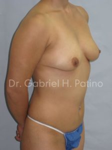  Before and After Cosmetic Surgery in Oakland, CA 