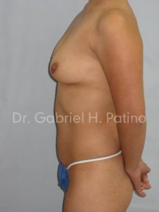  Before and After Cosmetic Surgery in Oakland, CA 