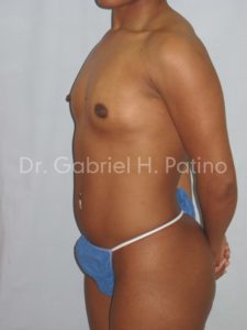  Before and After Cosmetic Surgery in Oakland, CA 