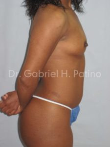  Before and After Cosmetic Surgery in Oakland, CA 