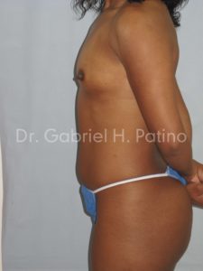  Before and After Cosmetic Surgery in Oakland, CA 