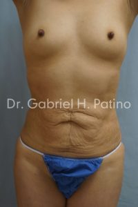  Before and After Cosmetic Surgery in Oakland, CA 