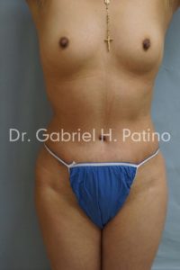  Before and After Cosmetic Surgery in Oakland, CA 