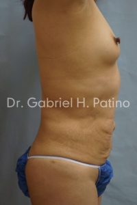  Before and After Cosmetic Surgery in Oakland, CA 