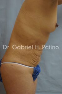  Before and After Cosmetic Surgery in Oakland, CA 