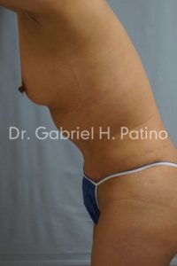  Before and After Cosmetic Surgery in Oakland, CA 