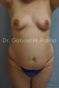  Before and After Cosmetic Surgery in Oakland, CA 