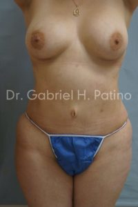  Before and After Cosmetic Surgery in Oakland, CA 