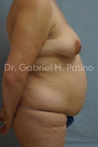  Before and After Cosmetic Surgery in Oakland, CA 