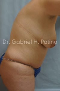  Before and After Cosmetic Surgery in Oakland, CA 