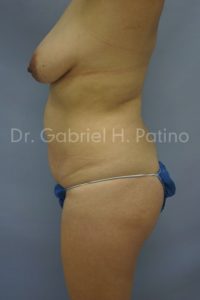  Before and After Cosmetic Surgery in Oakland, CA 