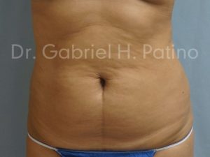  Before and After Cosmetic Surgery in Oakland, CA 