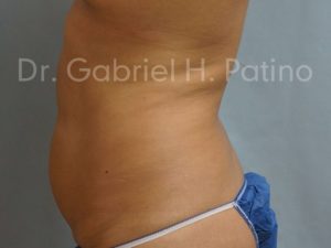  Before and After Cosmetic Surgery in Oakland, CA 