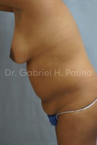  Before and After Cosmetic Surgery in Oakland, CA 