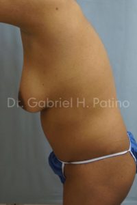  Before and After Cosmetic Surgery in Oakland, CA 