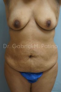  Before and After Cosmetic Surgery in Oakland, CA 