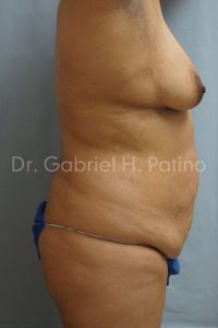  Before and After Cosmetic Surgery in Oakland, CA 