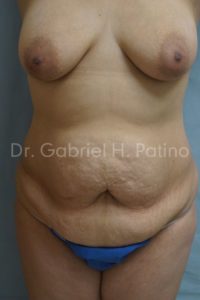  Before and After Cosmetic Surgery in Oakland, CA 