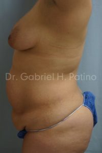  Before and After Cosmetic Surgery in Oakland, CA 