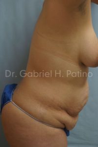  Before and After Cosmetic Surgery in Oakland, CA 