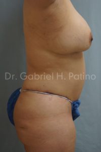  Before and After Cosmetic Surgery in Oakland, CA 