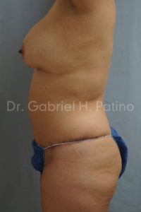  Before and After Cosmetic Surgery in Oakland, CA 