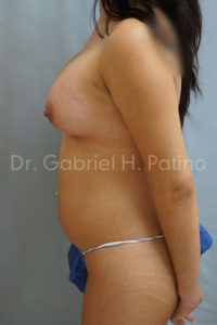  Before and After Cosmetic Surgery in Oakland, CA 