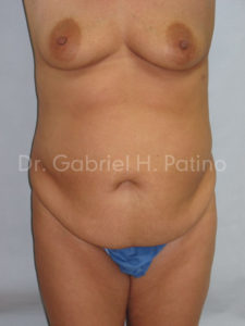  Before and After Cosmetic Surgery in Oakland, CA 