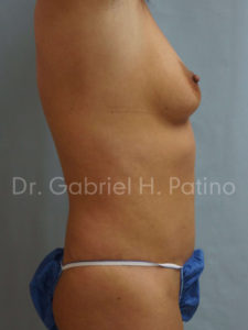  Before and After Cosmetic Surgery in Oakland, CA 