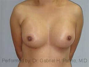  Before and After Cosmetic Surgery in Oakland, CA 