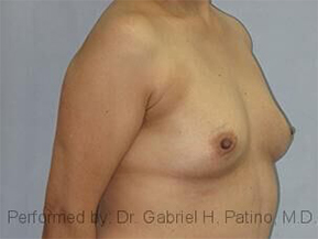  Before and After Cosmetic Surgery in Oakland, CA 