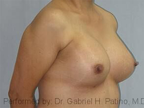  Before and After Cosmetic Surgery in Oakland, CA 