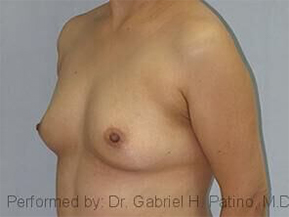  Before and After Cosmetic Surgery in Oakland, CA 