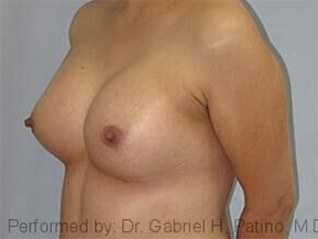  Before and After Cosmetic Surgery in Oakland, CA 